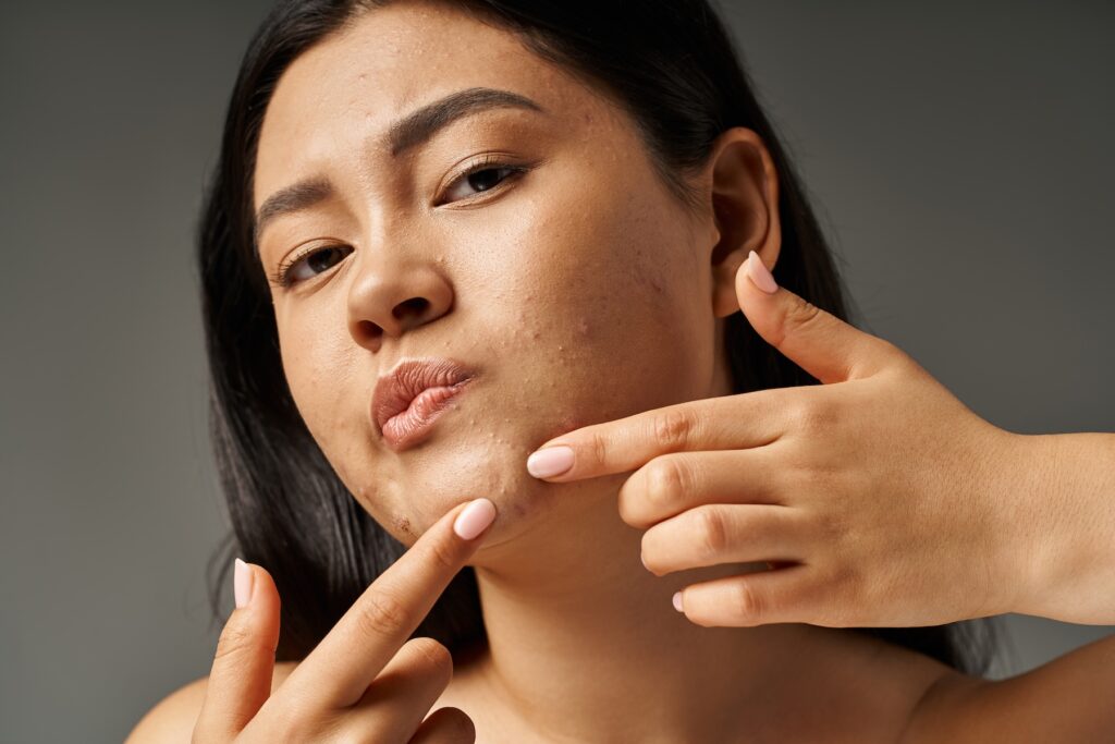 Woman considering an Acne Treatments in Walnut Creek while looking at her skin up close